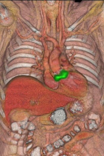 endocarditis válvula aórtica