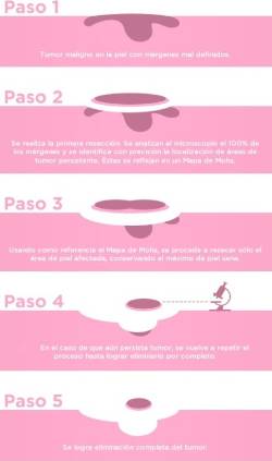 Pasos Cirugía Micrográfica de Mohs
