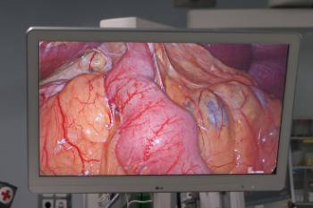 cirugia-obesidad-bypass-gastrico-cirugia-bariatrica-gastrectomia-cervical