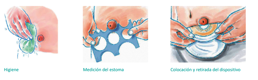 higiene del estoma