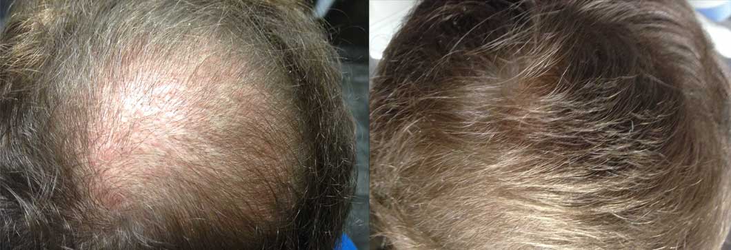 trasplante-de-pelo_antes_despues