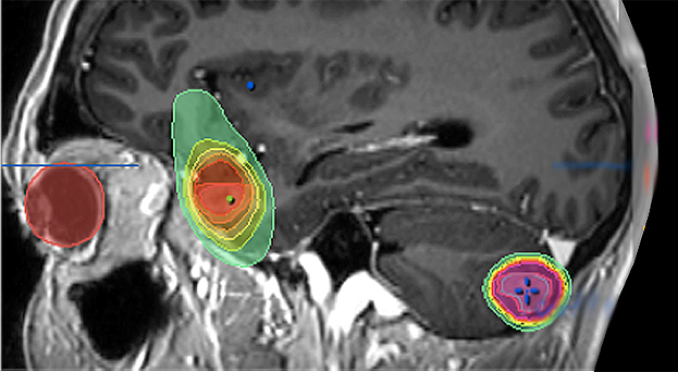 jornada_metasstasis_grande