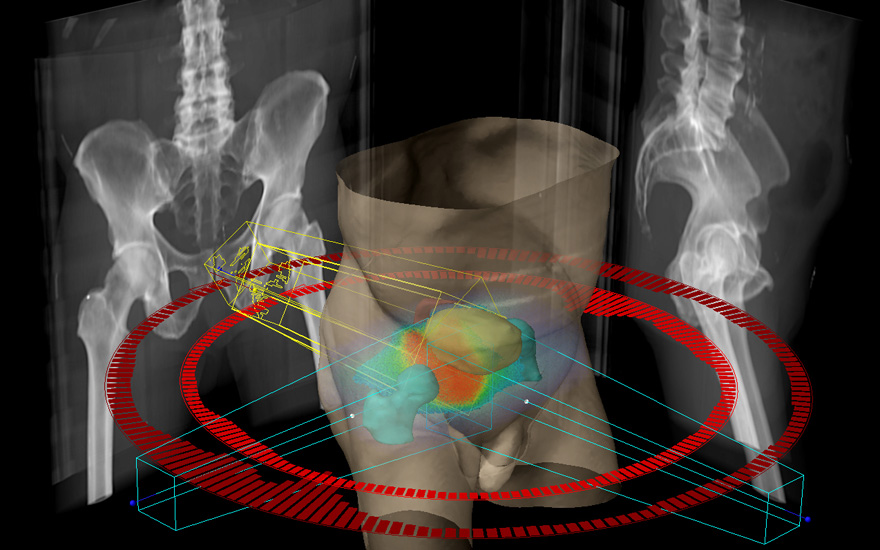 tratamiento_cancer_prostata