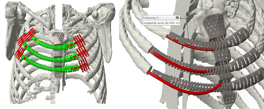 costillas_de_titanio1
