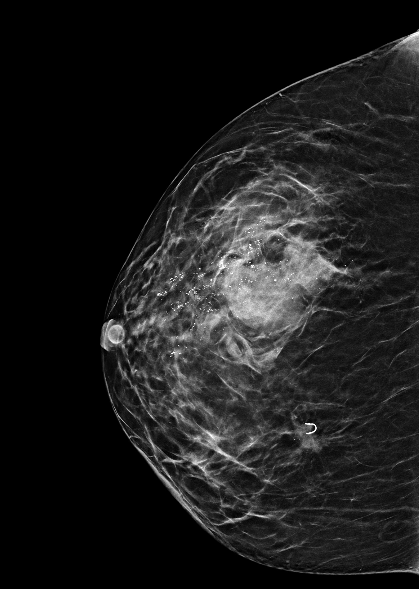 mamografía craneocaudal mama jpg