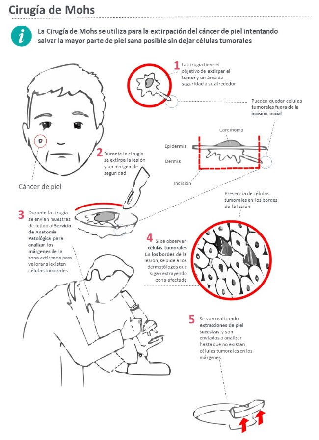 Cirugía_de_Mohs