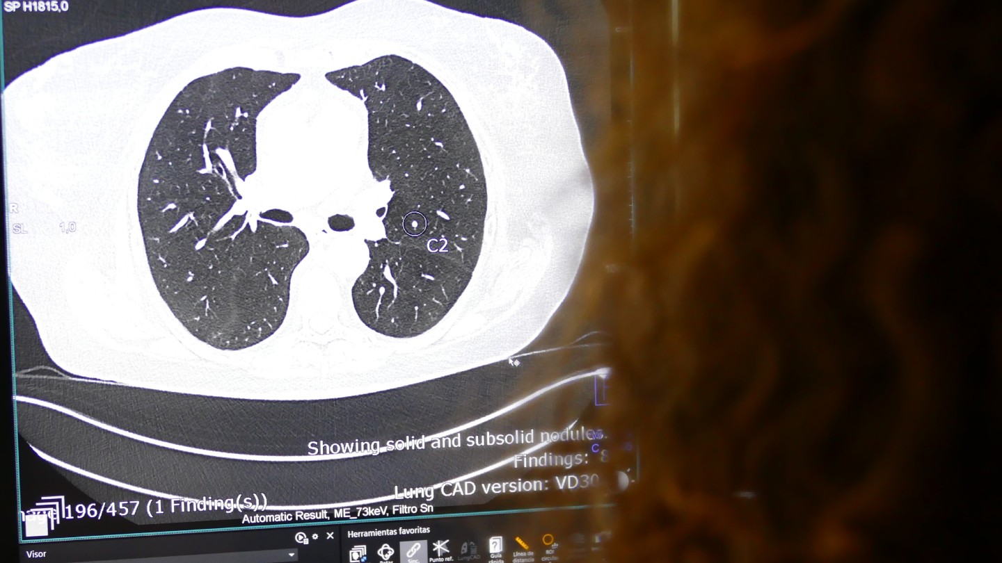 IA en Diagnóstico por la Imagen4_nodulo pulmonar