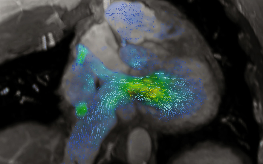 4d_flow_trasposicion-de-grandes-arterias1