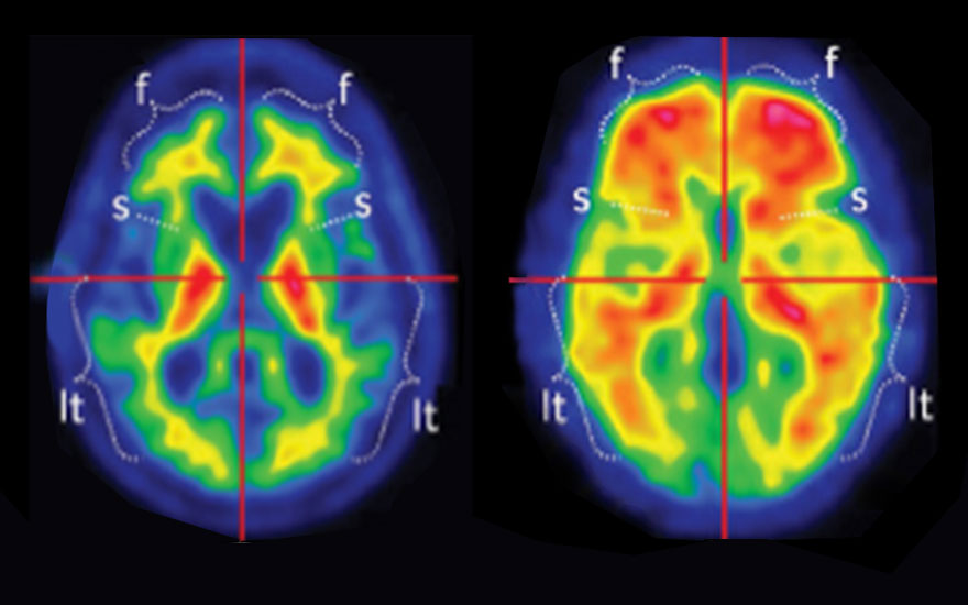 beta_amiloide_alzheimer