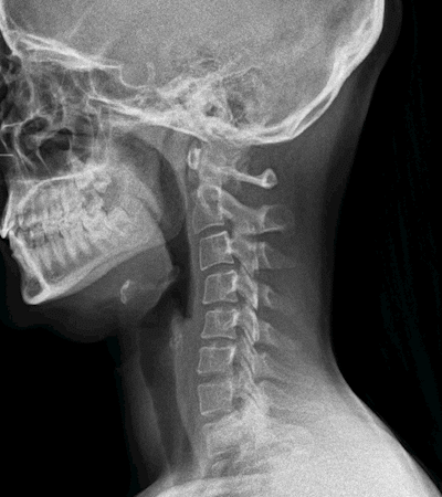 radiologia digital dinamica cervicales