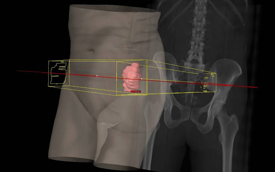 planificador en 3D del tratamiento_en rojo la zona radiada