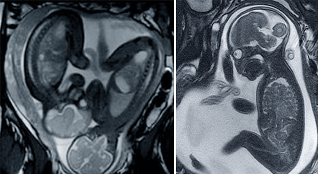 resonancia_fetal_grande