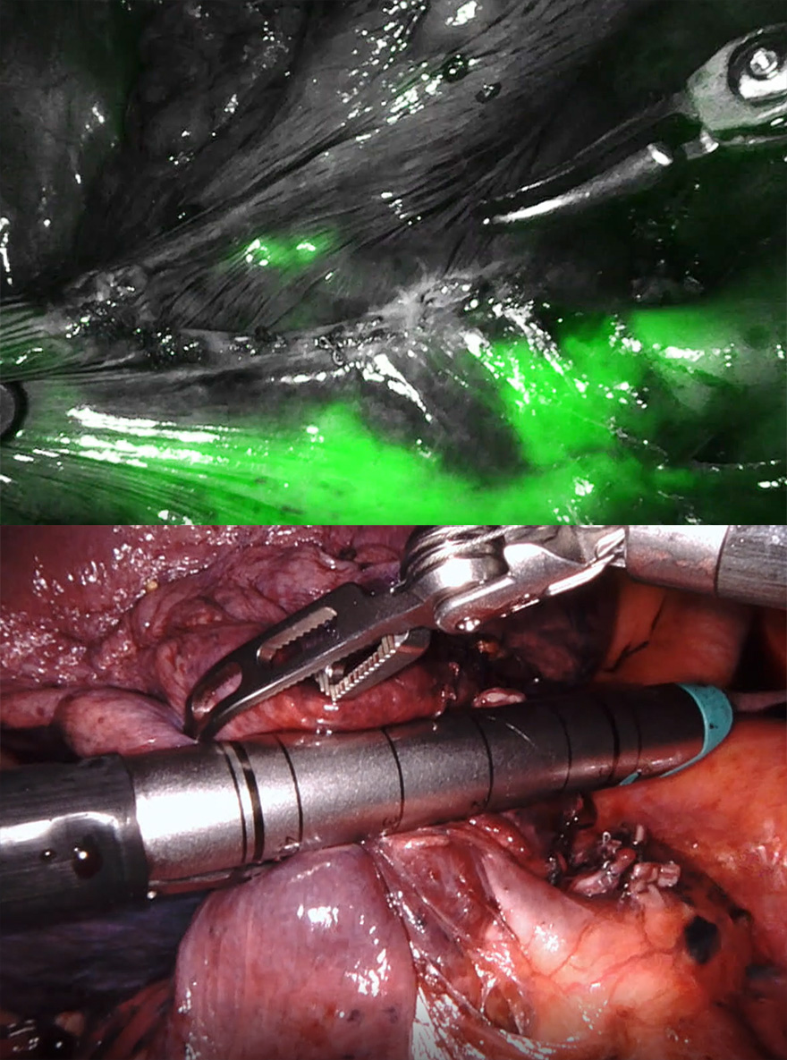 cirugia_pulmonar_verde_indocianina