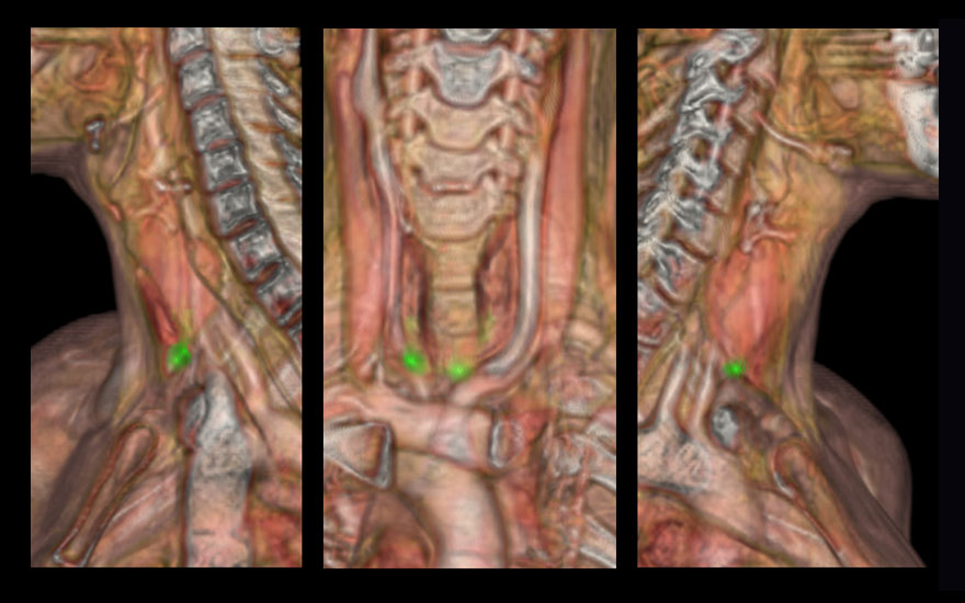 adenoma_paratoroides