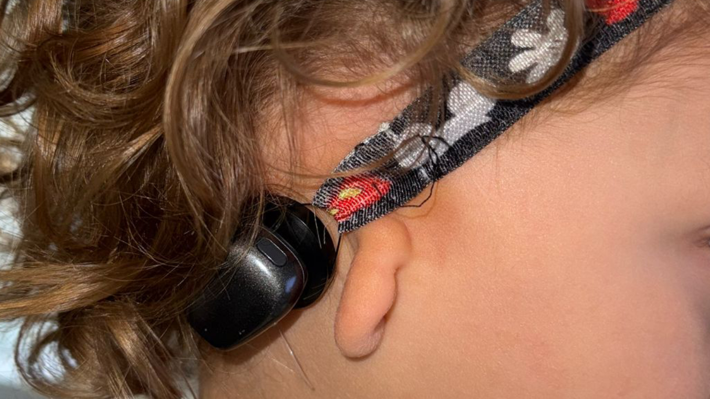 microtia-vibrador-oseo