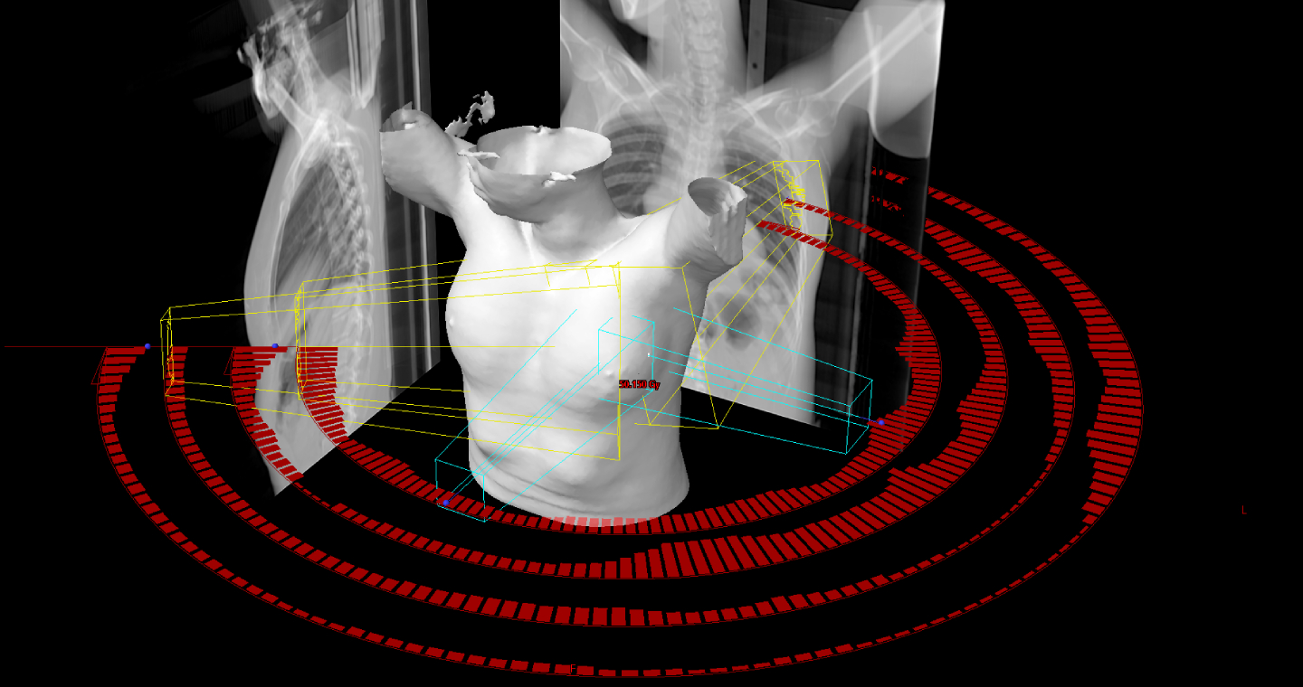 Tratamiento Mama SIB IMRT _1