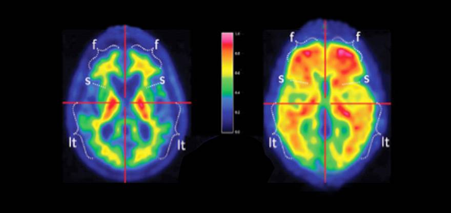 placas_beta_amiloide_sano_alzheimer