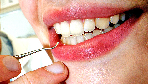 extracciones-odontologicas