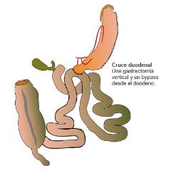 cruce_duodenal_madrid