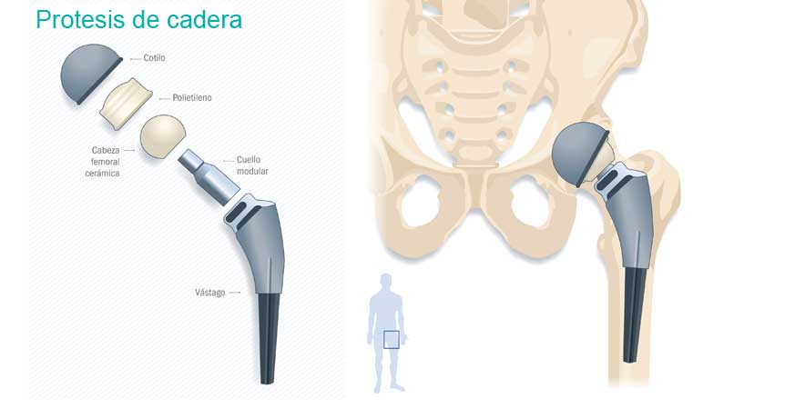 web_traumatologia_protesis_cadera