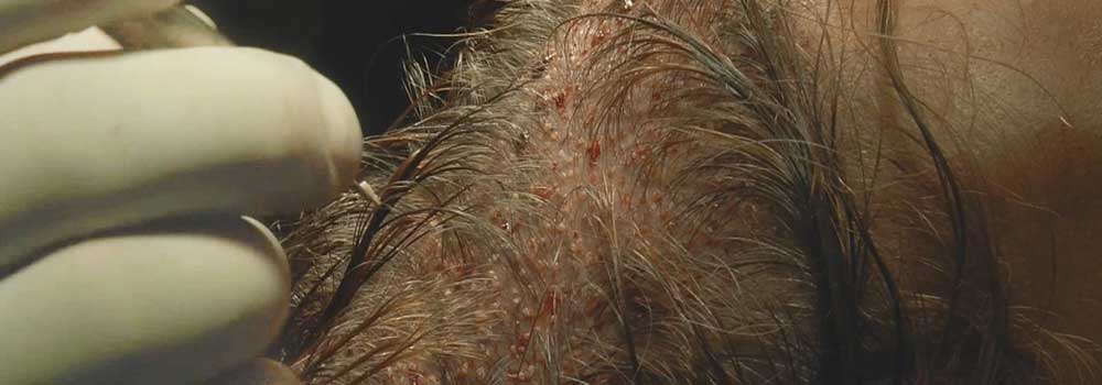 trasplante_pelo_intervencion_primer_plano