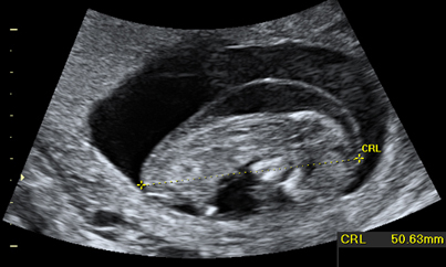 eco_primer_trimestre_patologica