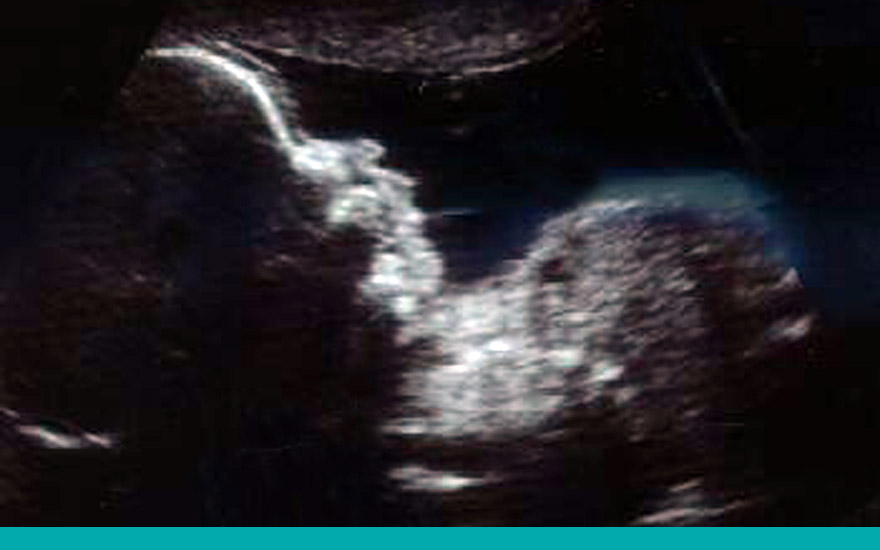 ecografia fetal