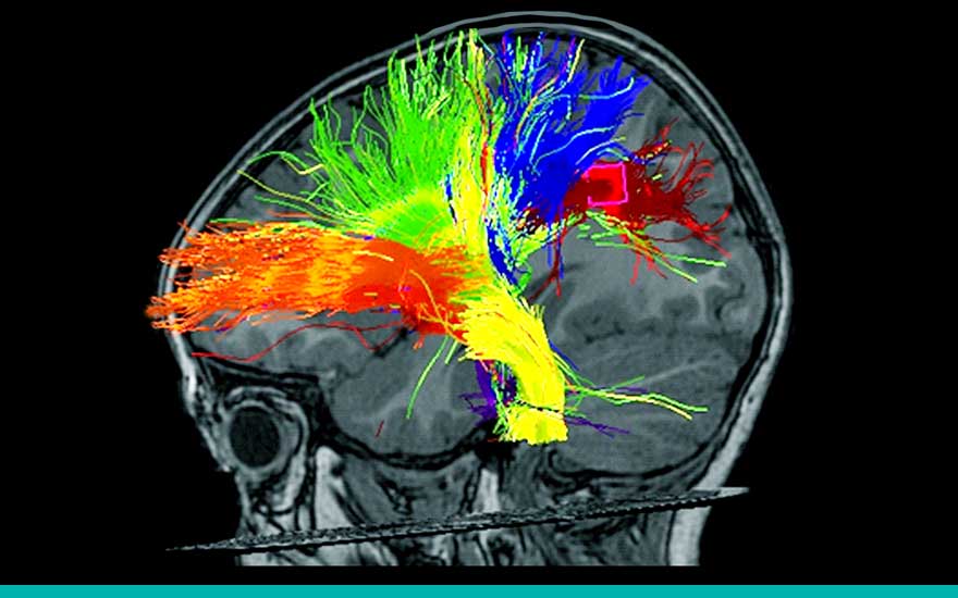 resonancia_magnetica_cerebral