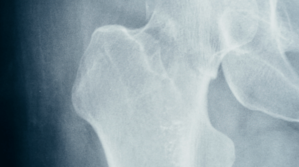 lesion cadera murcia quironsalud