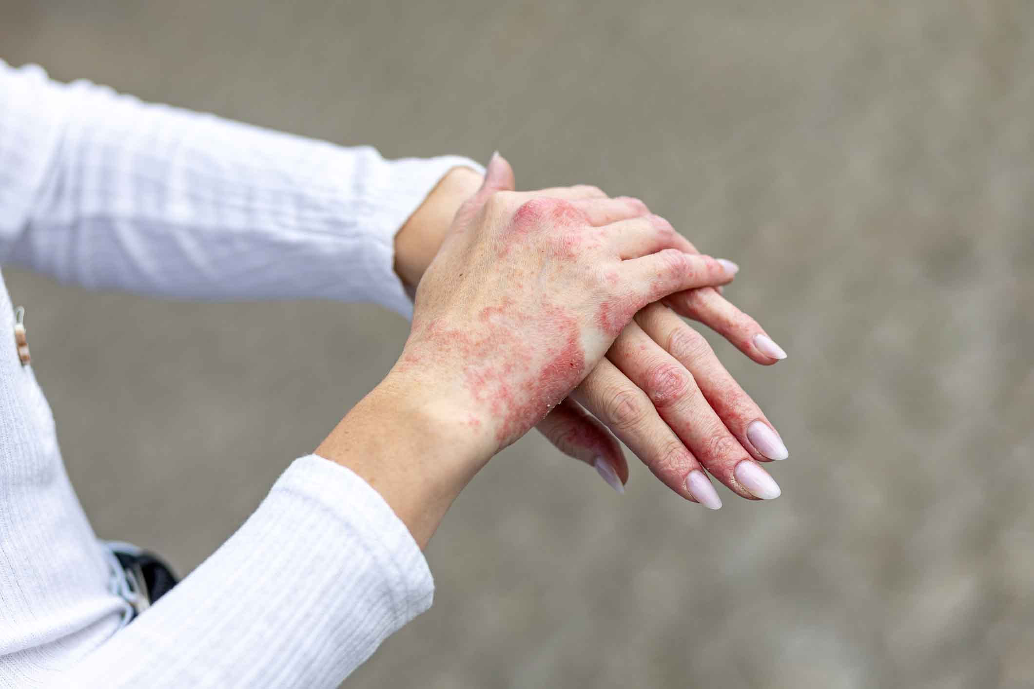 Psoriasis