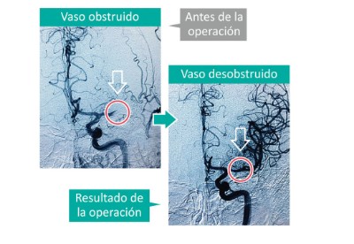 intervencionismo_ictus