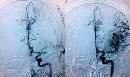 Ictus antes y después