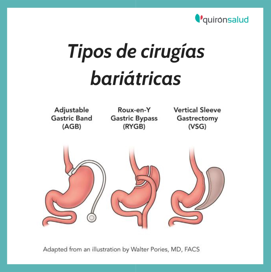 cirugia de la obesidad quironsalud tenerife