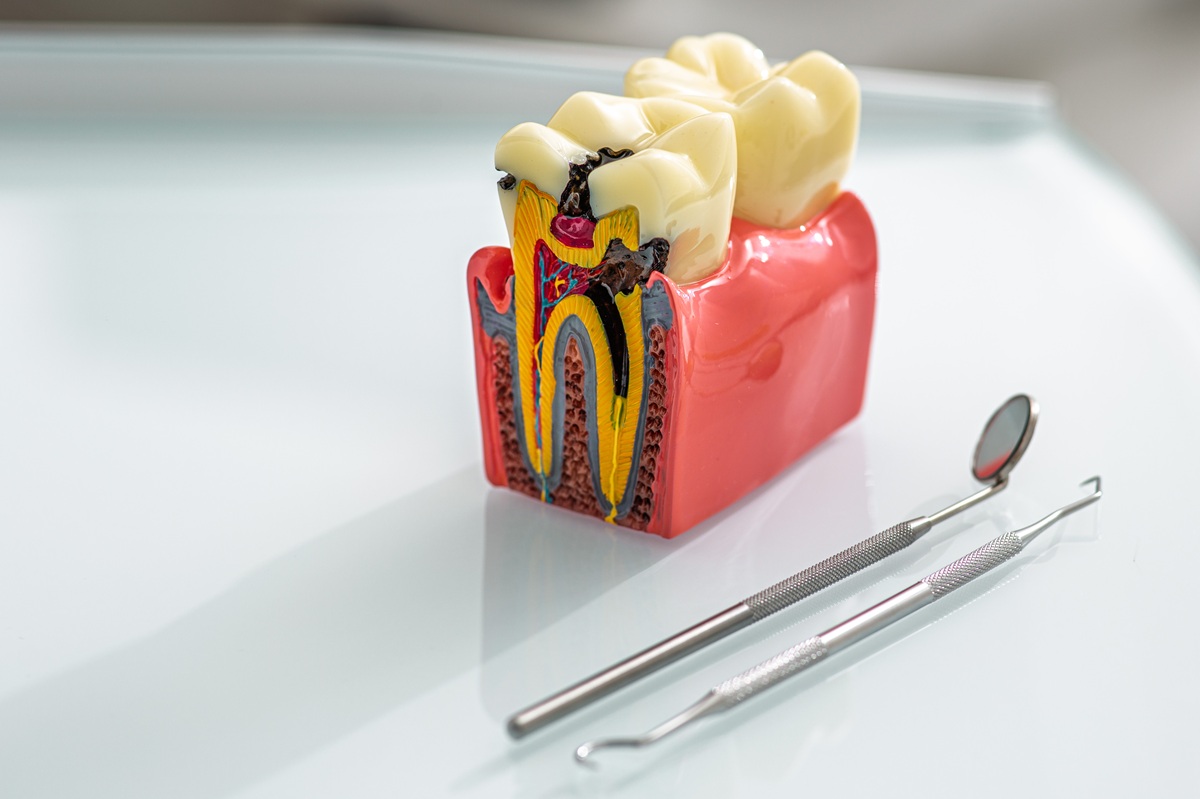 endodoncia quironsalud tenerife
