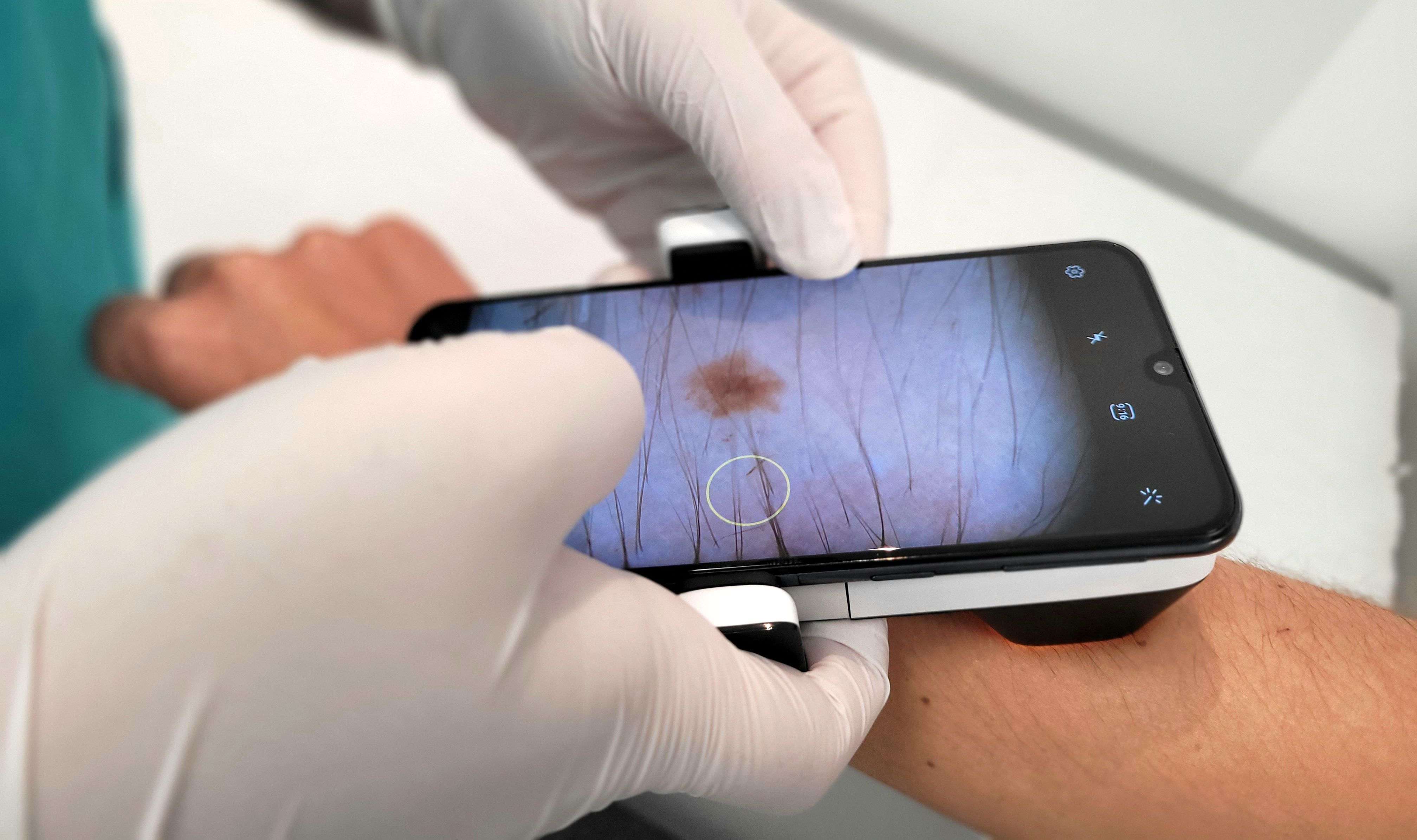 Dermatoscopio-Teledermatología