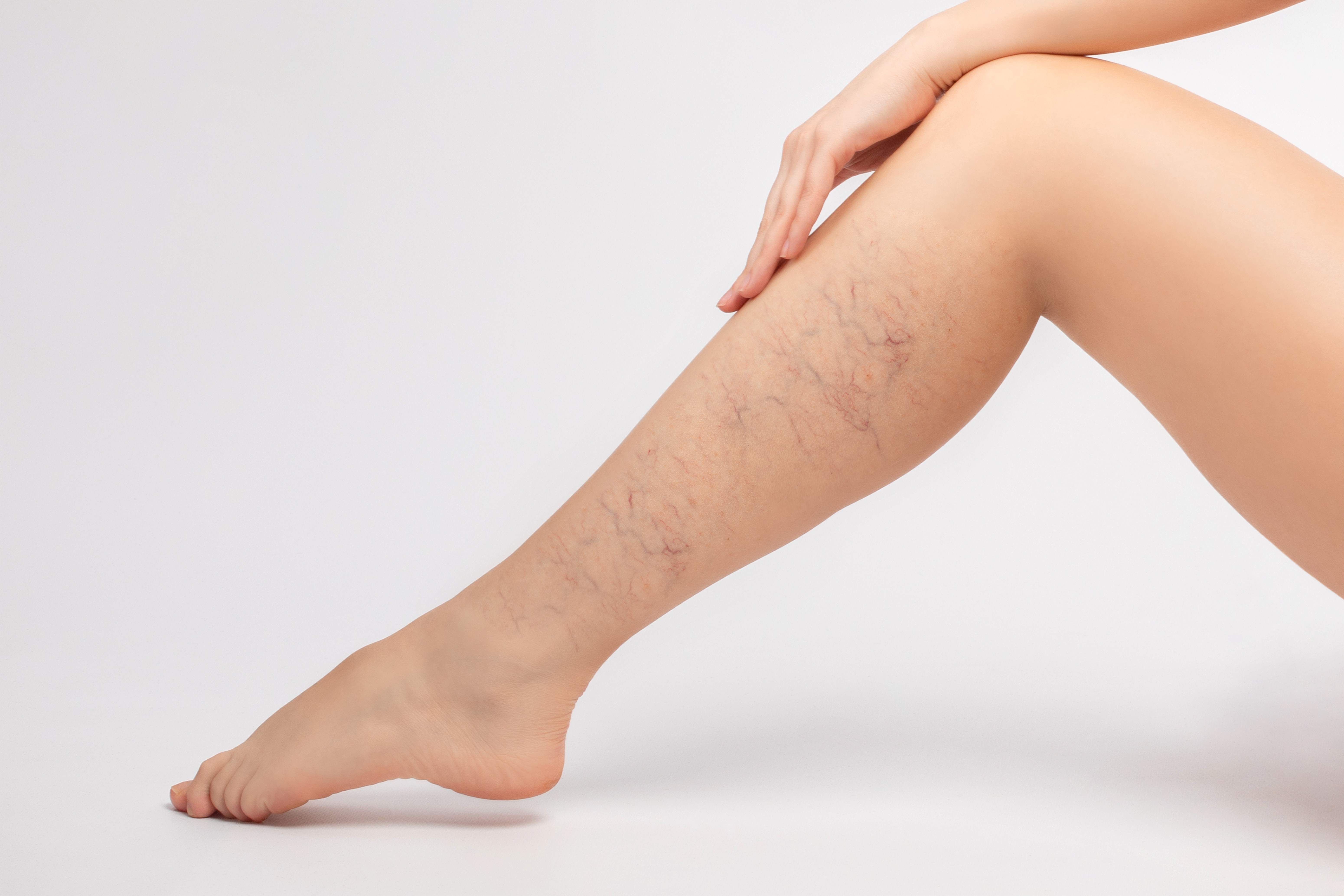 Escleroterapia web