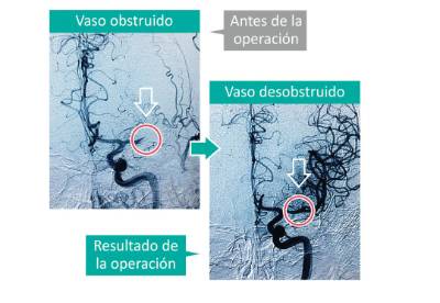 intervencionismo_ictus