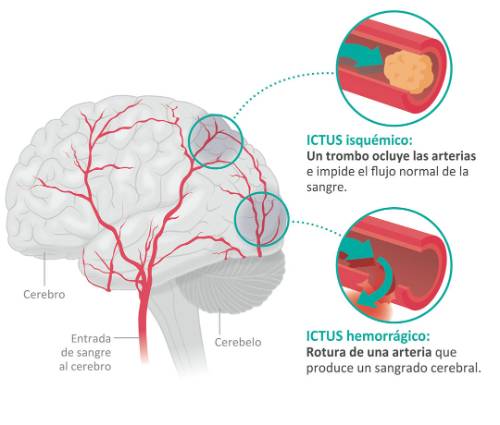 ictus
