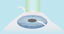 CR-Miopia-LASIK-paso-02