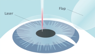 CPresbicia-Cirugia-laser-FEMTOLASIK-paso-01
