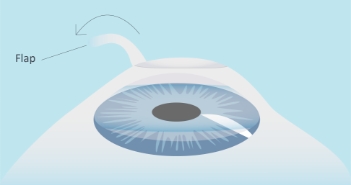 CPresbicia-Cirugia-laser-LASIK-paso-01