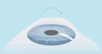 CPresbicia-Cirugia-laser-paso-03