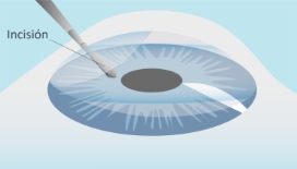 CPresbicia-LENTES-paso-01