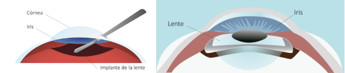 CPresbicia-LENTES-paso-03