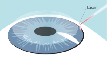 Glaucoma-Trabeculoplastia-01