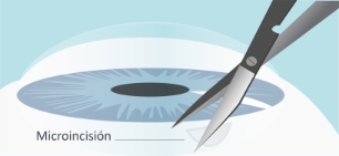 Glaucoma-Trabeculetomia-paso-01