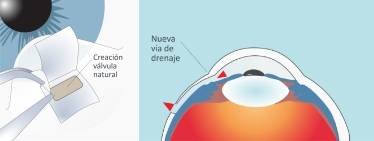 Glaucoma-Trabeculetomia-paso-02