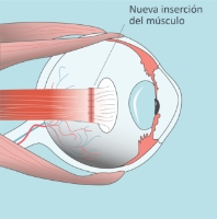 Estrabismo-infantil-paso-02