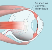 Estrabismo-infantil-paso-03