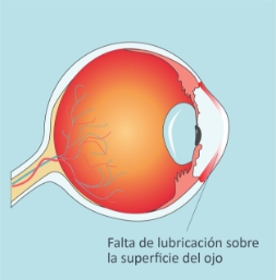Ojo-seco-QueEs-02